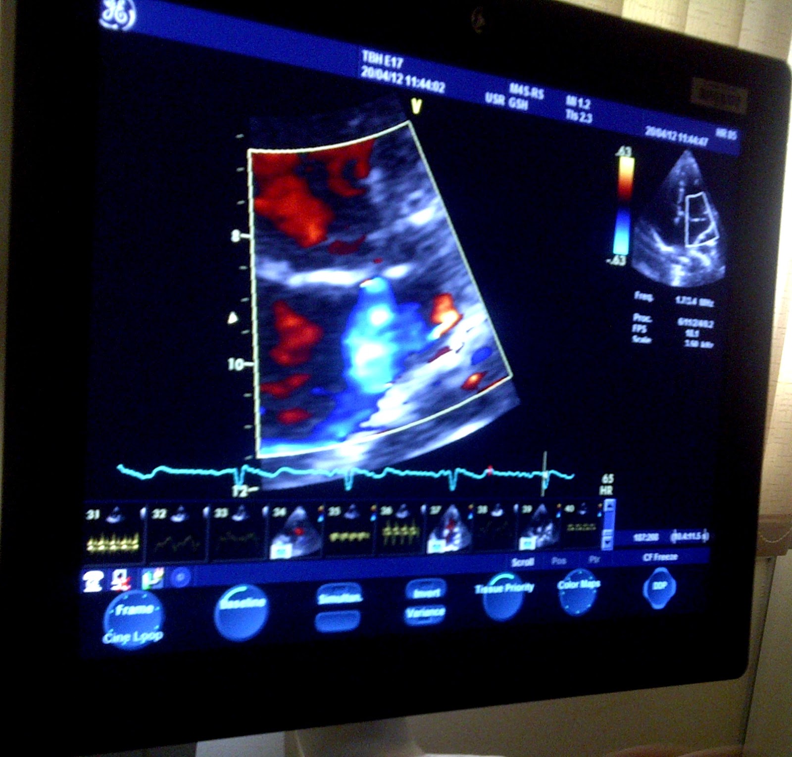 Kim_Mitral_Valve_Prolape_Echo