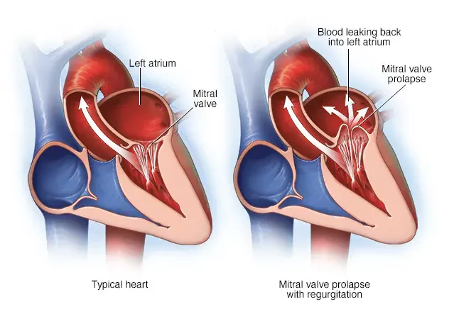 Mitral_Valve_Prolapse
